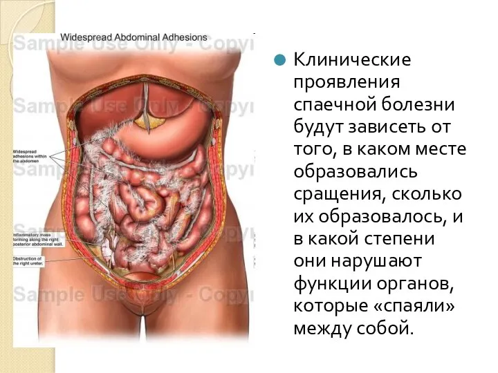 Клинические проявления спаечной болезни будут зависеть от того, в каком месте