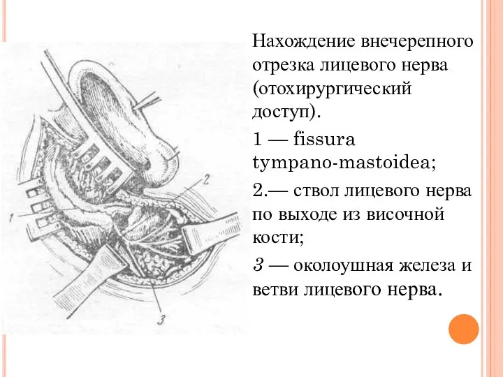 Нахождение внечерепного отрезка лицевого нерва (отохирургический доступ). 1 — fissura tympano-mastoidea;