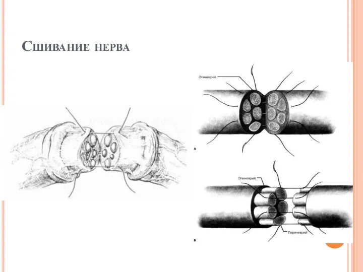 Сшивание нерва