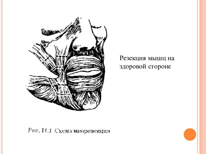 Резекция мышц на здоровой стороне