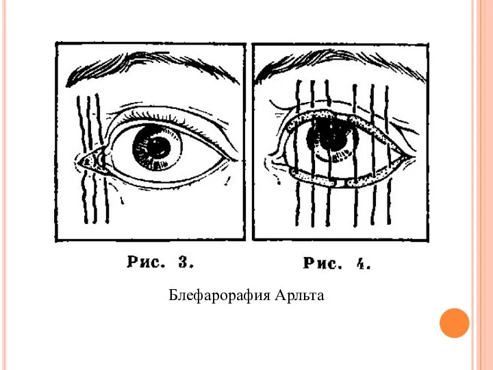 Блефарорафия Арльта