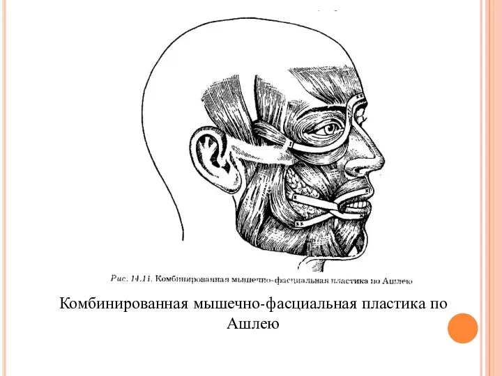 Комбинированная мышечно-фасциальная пластика по Ашлею