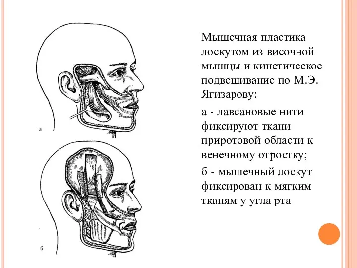 Мышечная пластика лоскутом из височной мышцы и кинетическое подвешивание по М.Э.