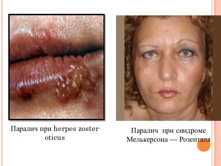 Паралич при herpes zoster oticus Паралич при синдроме Мелькерсона — Розенталя