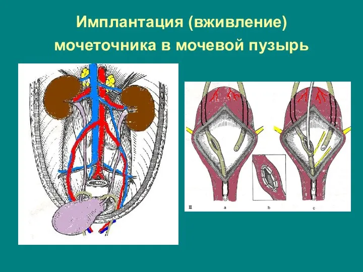 Имплантация (вживление) мочеточника в мочевой пузырь