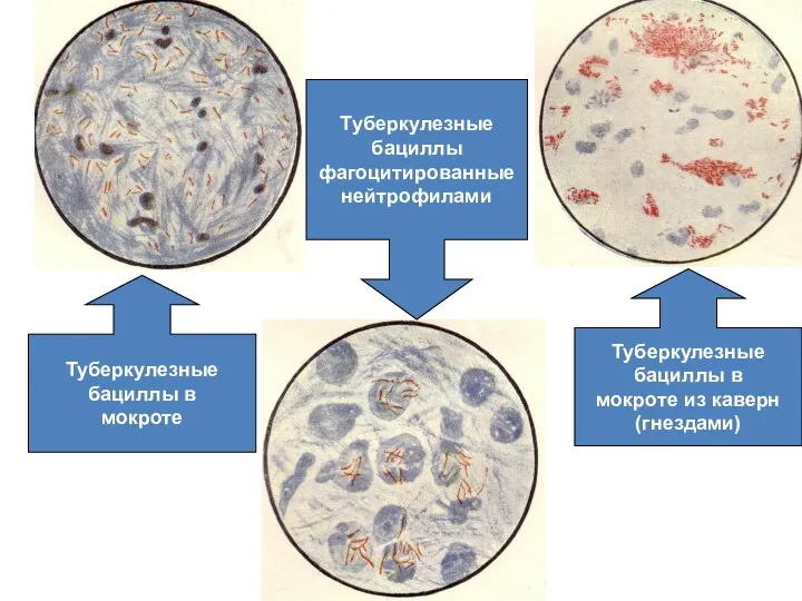 Туберкулезные бациллы в мокроте Туберкулезные бациллы в мокроте из каверн (гнездами) Туберкулезные бациллы фагоцитированные нейтрофилами