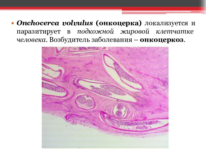 Onchocerca volvulus (онкоцерка) локализуется и паразитирует в подкожной жировой клетчатке человека. Возбудитель заболевания – онкоцеркоз.