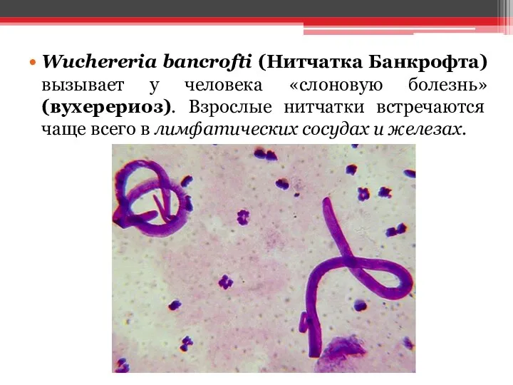 Wuchereria bancrofti (Нитчатка Банкрофта) вызывает у человека «слоновую болезнь» (вухерериоз). Взрослые