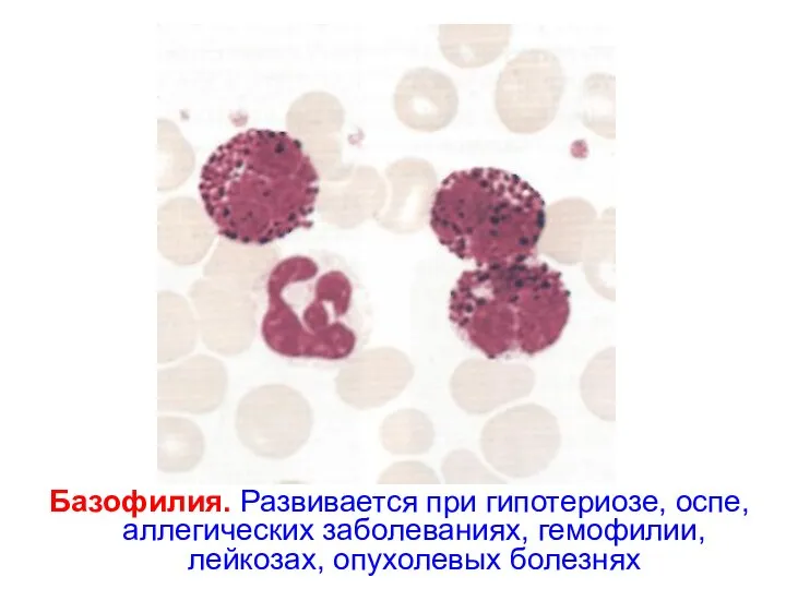 Базофилия. Развивается при гипотериозе, оспе, аллегических заболеваниях, гемофилии, лейкозах, опухолевых болезнях