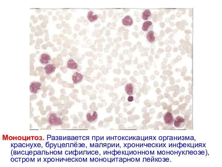 Моноцитоз. Развивается при интоксикациях организма, краснухе, бруцеллёзе, малярии, хронических инфекциях (висцеральном