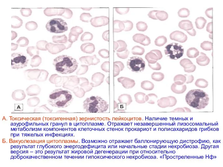 А. Токсическая (токсигенная) зернистость лейкоцитов. Наличие темных и азурофильных гранул в