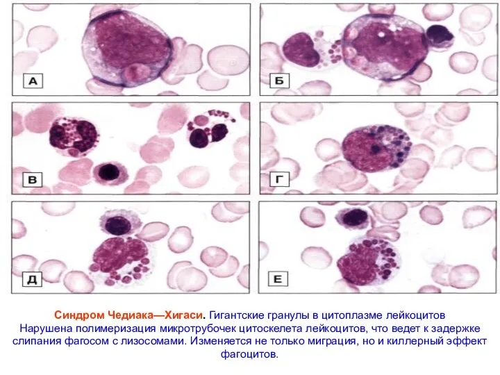 Синдром Чедиака—Хигаси. Гигантские гранулы в цитоплазме лейкоцитов Нарушена полимеризация микротрубочек цитоскелета