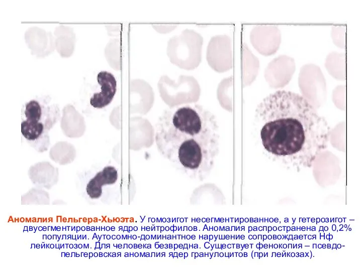 Аномалия Пельгера-Хьюэта. У гомозигот несегментированное, а у гетерозигот – двусегментированное ядро