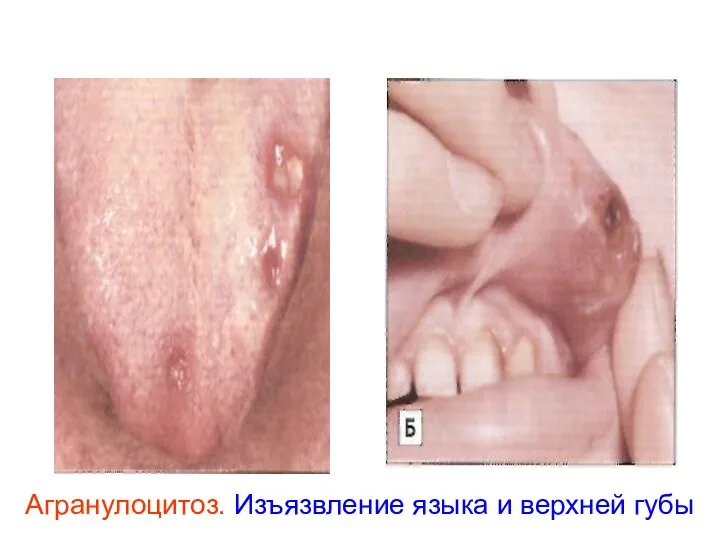 Агранулоцитоз. Изъязвление языка и верхней губы