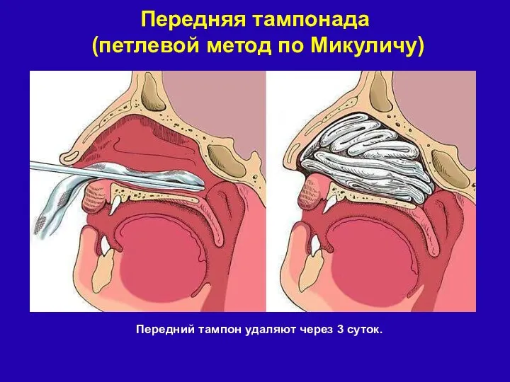 Передняя тампонада (петлевой метод по Микуличу) Передний тампон удаляют через 3 суток.