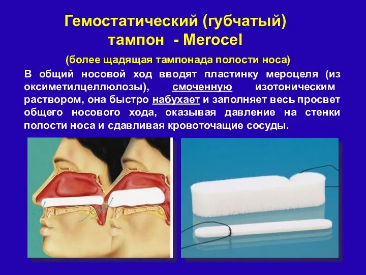 (более щадящая тампонада полости носа) В общий носовой ход вводят пластинку