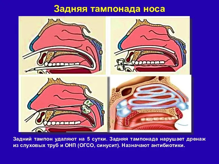 Задний тампон удаляют на 5 сутки. Задняя тампонада нарушает дренаж из