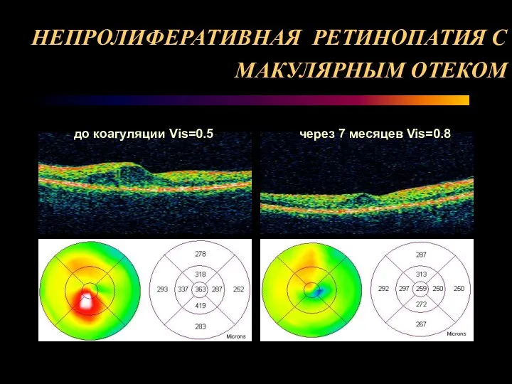 НЕПРОЛИФЕРАТИВНАЯ РЕТИНОПАТИЯ С МАКУЛЯРНЫМ ОТЕКОМ до коагуляции Vis=0.5 через 7 месяцев Vis=0.8