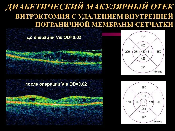 до операции Vis OD=0.02 после операции Vis OD=0.02 ДИАБЕТИЧЕСКИЙ МАКУЛЯРНЫЙ ОТЕК