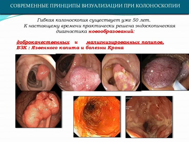 СОВРЕМЕННЫЕ ПРИНЦИПЫ ВИЗУАЛИЗАЦИИ ПРИ КОЛОНОСКОПИИ Гибкая колоноскопия существует уже 50 лет.