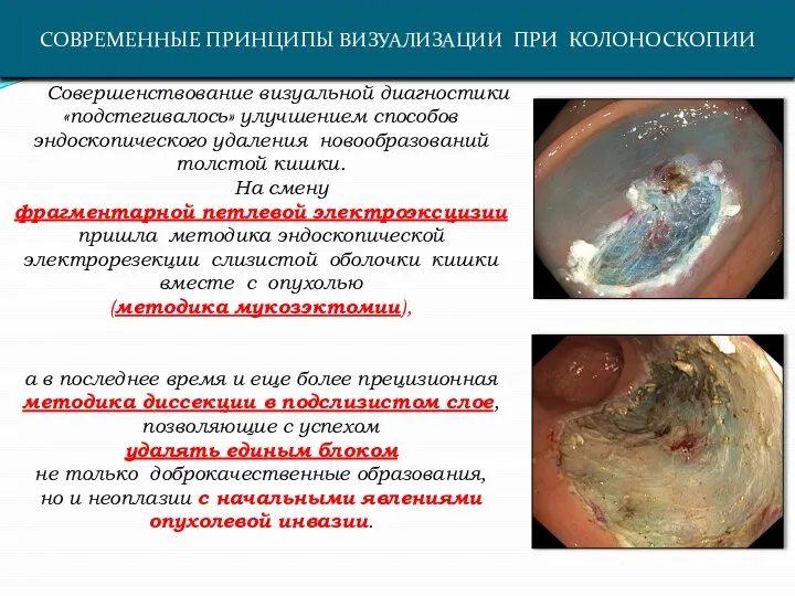 СОВРЕМЕННЫЕ ПРИНЦИПЫ ВИЗУАЛИЗАЦИИ ПРИ КОЛОНОСКОПИИ Совершенствование визуальной диагностики «подстегивалось» улучшением способов