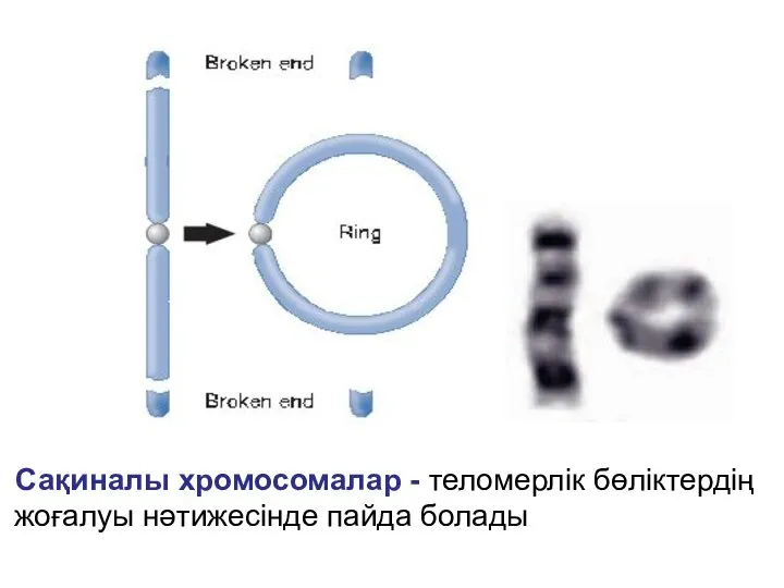 Сақиналы хромосомалар - теломерлік бөліктердің жоғалуы нәтижесінде пайда болады