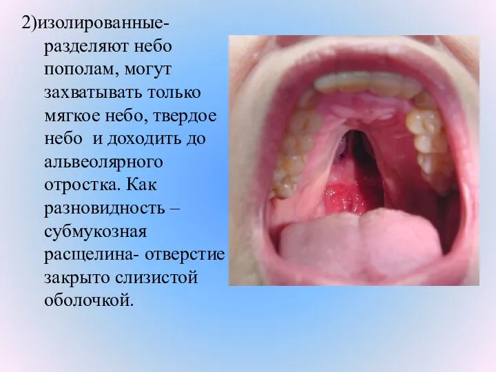 2)изолированные- разделяют небо пополам, могут захватывать только мягкое небо, твердое небо