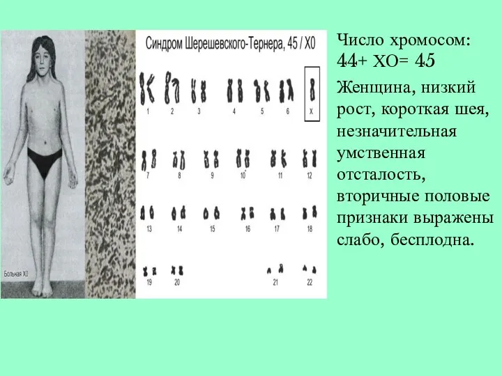 Число хромосом: 44+ ХО= 45 Женщина, низкий рост, короткая шея, незначительная