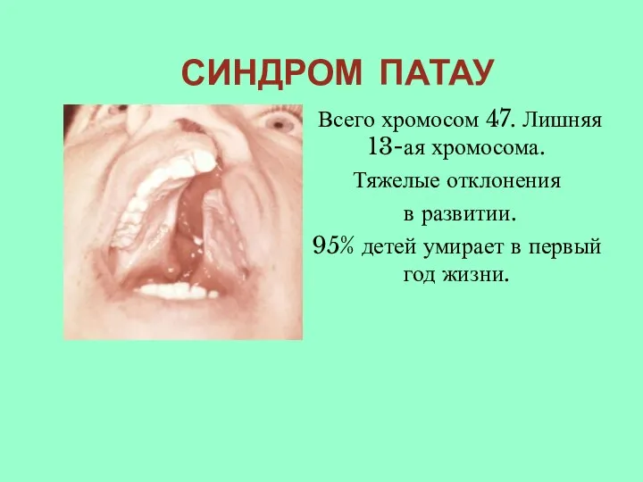 СИНДРОМ ПАТАУ Всего хромосом 47. Лишняя 13-ая хромосома. Тяжелые отклонения в