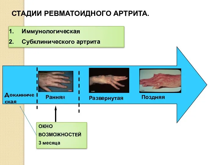 СТАДИИ РЕВМАТОИДНОГО АРТРИТА. Ранняя Развернутая Поздняя ОКНО ВОЗМОЖНОСТЕЙ 3 месяца Иммунологическая Субклинического артрита Доклиническая