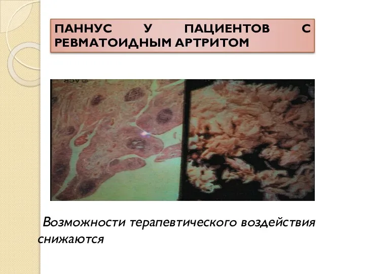 Возможности терапевтического воздействия снижаются ПАННУС У ПАЦИЕНТОВ С РЕВМАТОИДНЫМ АРТРИТОМ