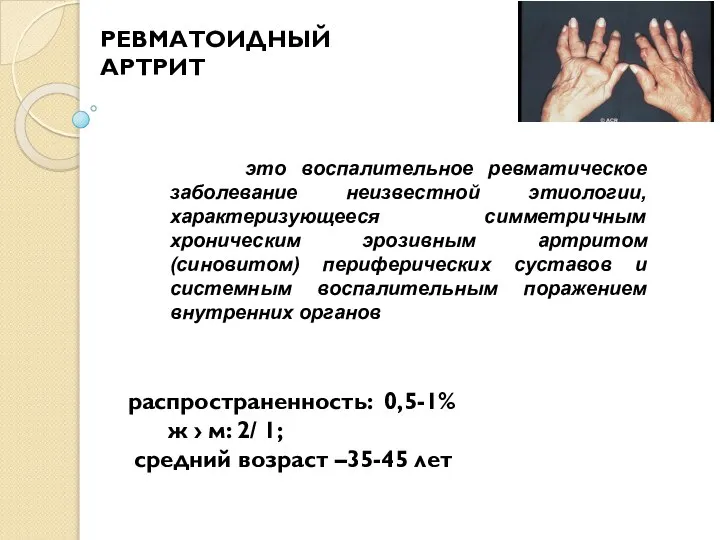 это воспалительное ревматическое заболевание неизвестной этиологии, характеризующееся симметричным хроническим эрозивным артритом