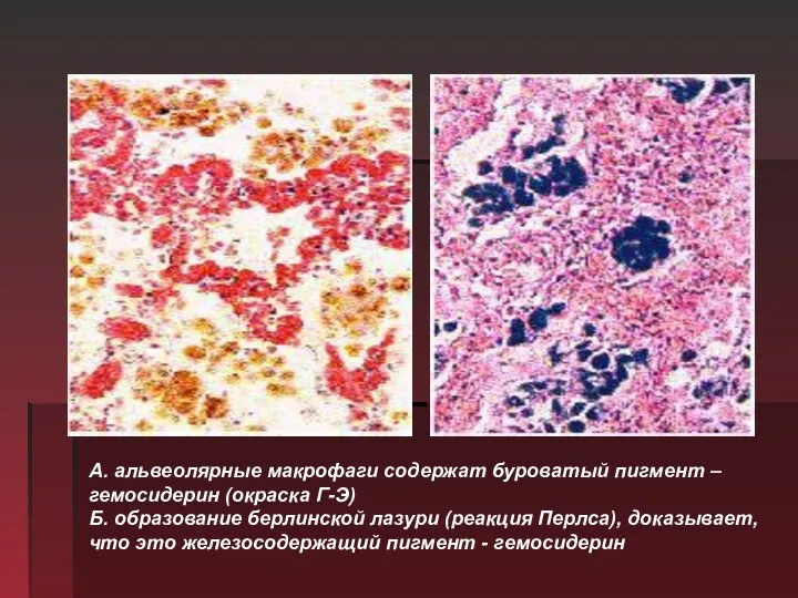 А. альвеолярные макрофаги содержат буроватый пигмент – гемосидерин (окраска Г-Э) Б.