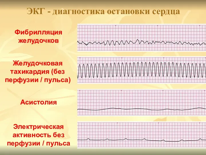 ЭКГ - диагностика остановки сердца Фибрилляция желудочков Желудочковая тахикардия (без перфузии