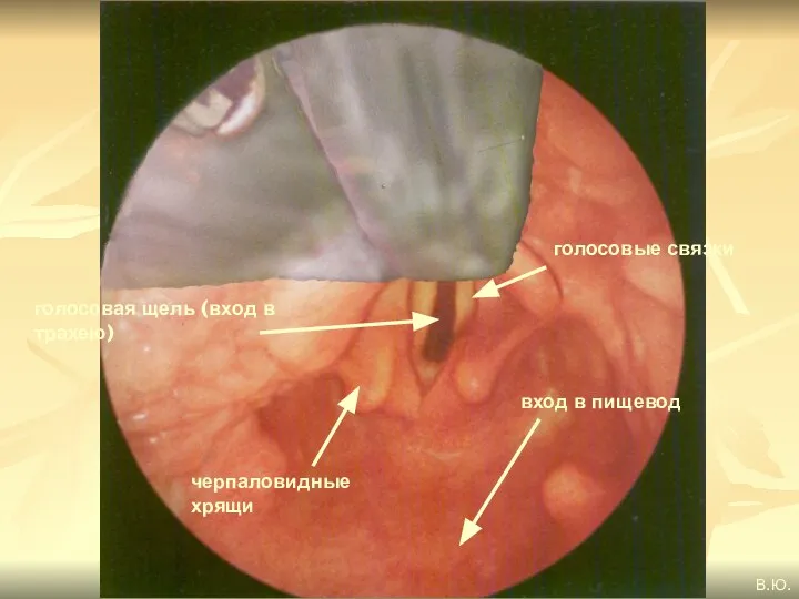 голосовые связки голосовая щель (вход в трахею) вход в пищевод В.Ю. черпаловидные хрящи
