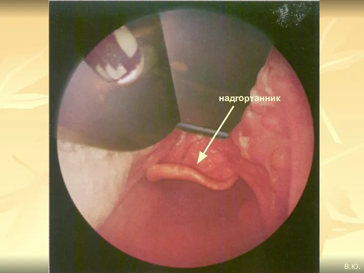 надгортанник В.Ю.