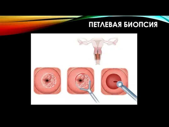 ПЕТЛЕВАЯ БИОПСИЯ