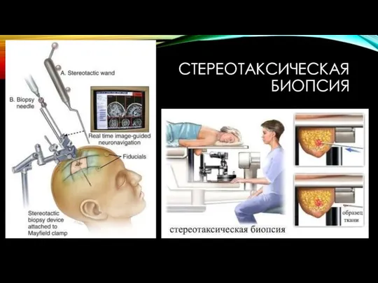 СТЕРЕОТАКСИЧЕСКАЯ БИОПСИЯ