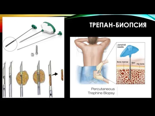 ТРЕПАН-БИОПСИЯ