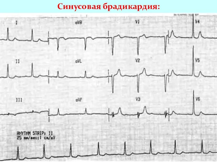 Синусовая брадикардия: