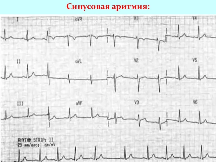 Синусовая аритмия: