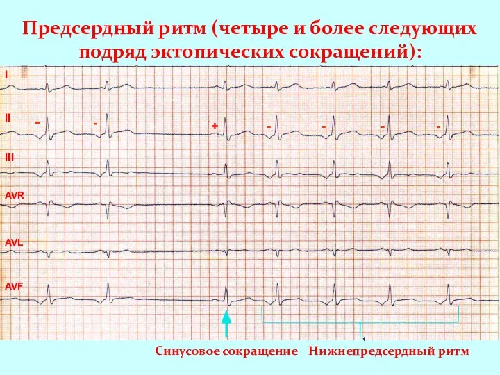 Предсердный ритм (четыре и более следующих подряд эктопических сокращений): I II