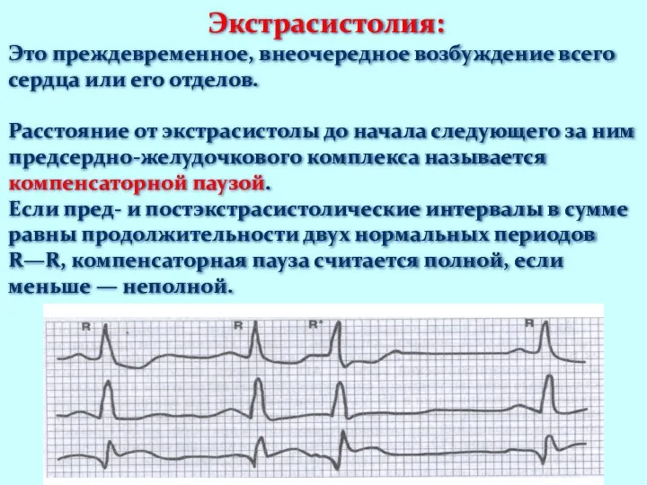 Экстрасистолия: Это преждевременное, внеочередное возбуждение всего сердца или его отделов. Расстояние