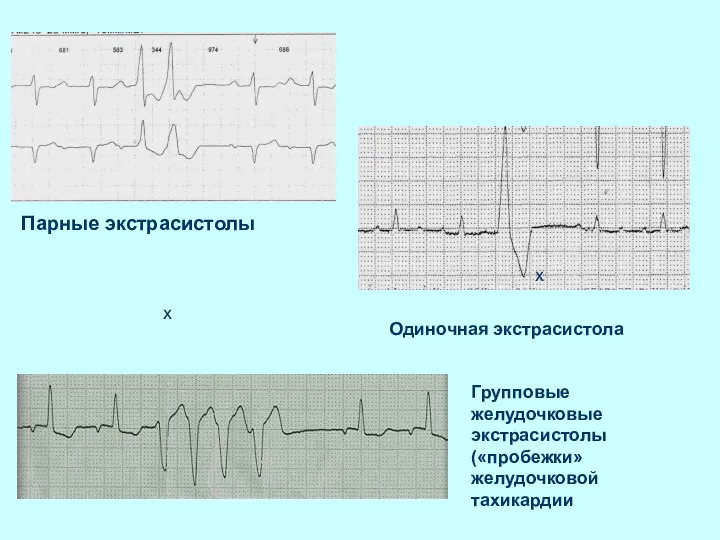 Парные экстрасистолы х Одиночная экстрасистола х Групповые желудочковые экстрасистолы («пробежки» желудочковой тахикардии