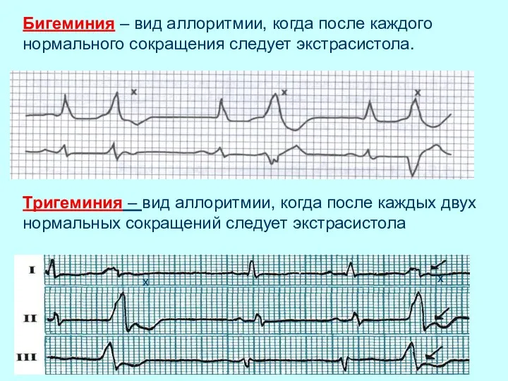 Бигеминия – вид аллоритмии, когда после каждого нормального сокращения следует экстрасистола.