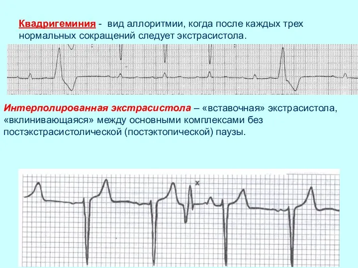 Интерполированная экстрасистола – «вставочная» экстрасистола, «вклинивающаяся» между основными комплексами без постэкстрасистолической