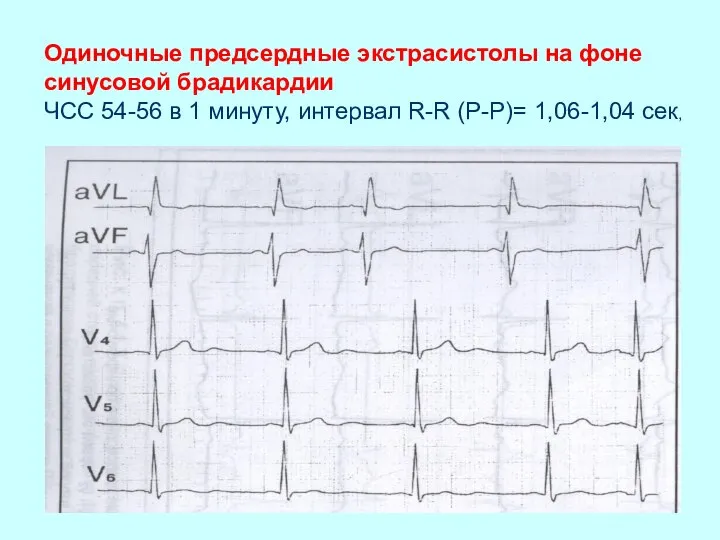 Одиночные предсердные экстрасистолы на фоне синусовой брадикардии ЧСС 54-56 в 1