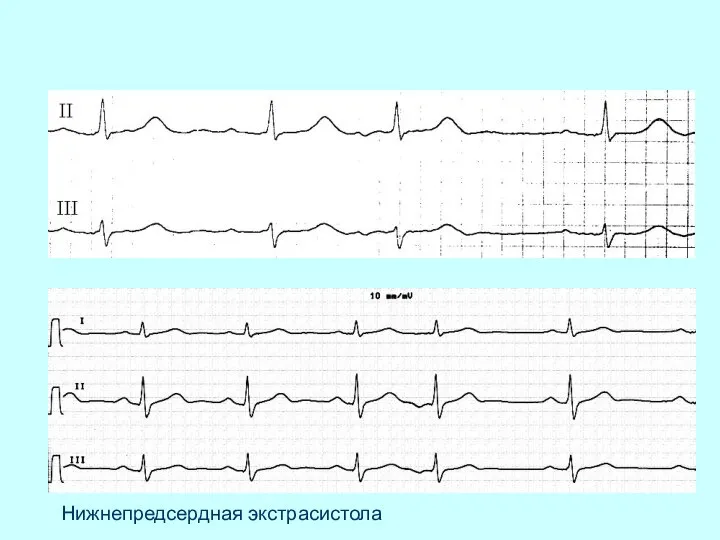 Нижнепредсердная экстрасистола