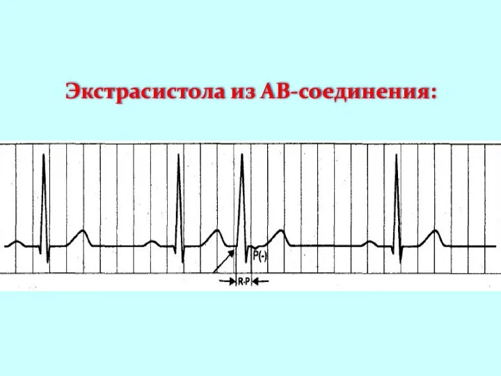 Экстрасистола из АВ-соединения: