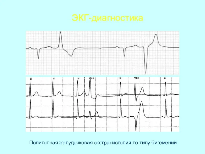 ЭКГ-диагностика Политопная желудочковая экстрасистолия по типу бигемений